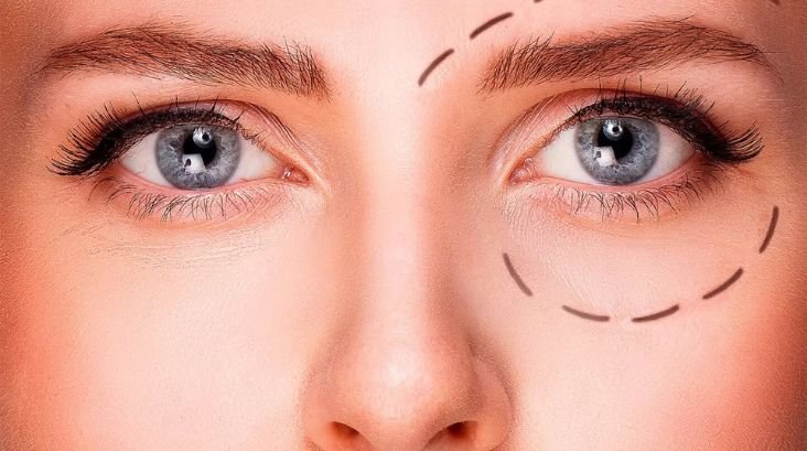 Ptosis Treatment in India